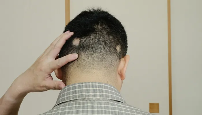 Alopecia