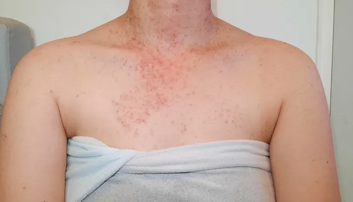 Folliculitis