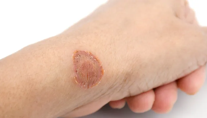 Fungal Infections