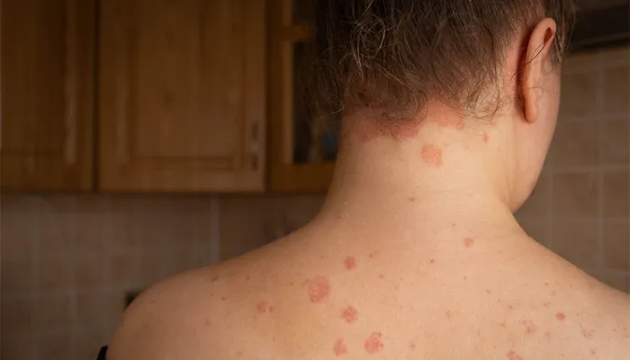 Psoriasis