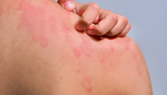Urticaria
