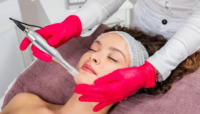 Image of Microneedling with PRP Section 4