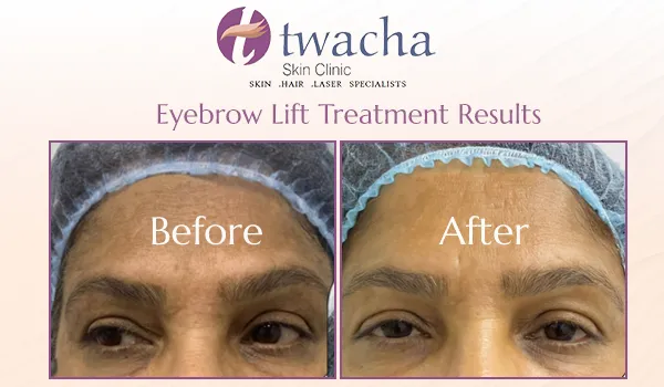 Anti-Wrinkle Treatment Brow Lift
