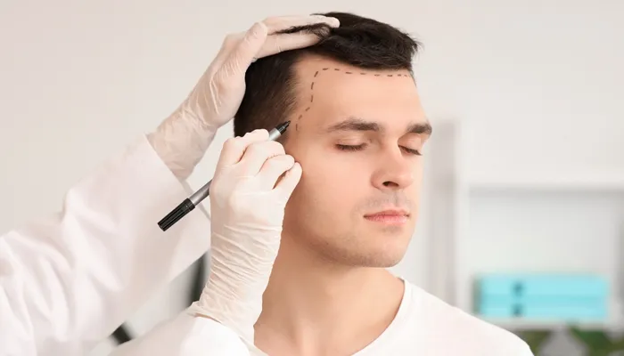 Scalp Micropigmentation